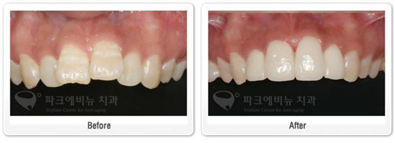 앞니치아성형 전후