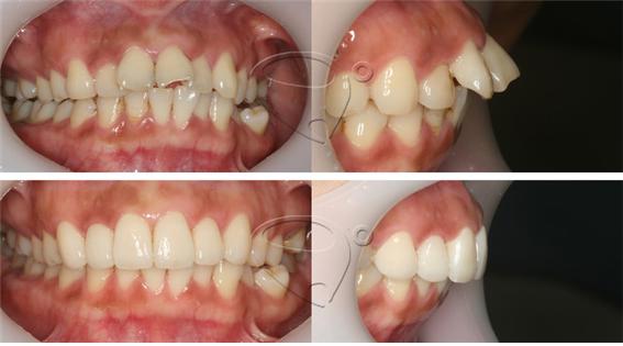 앞니돌출, 돌출된 앞니