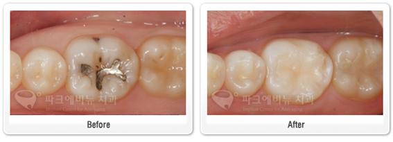 아말감교체-레진인레이