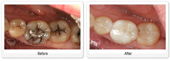 아말감교체 - 크라운치료