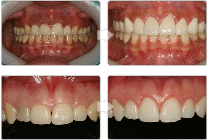 잇몸성형 후 심미치료
