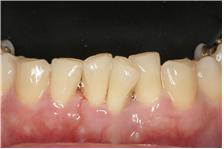 앞니치아성형순서1