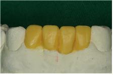 앞니치아성형순서2