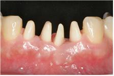 앞니치아성형순서3