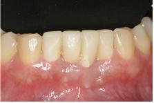 앞니치아성형순서4