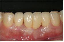 앞니치아성형순서5