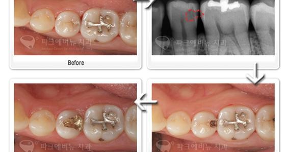 하얀색 치아를 위한 오래된 아말감교체 치료 상담사례