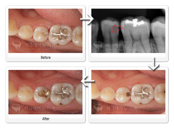 옆면 충치치료 - 금 인레이 치료