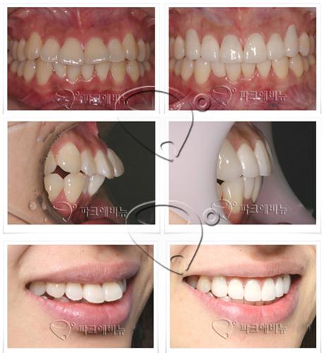 돌출이치아성형-올세라믹 크라운 치아성형