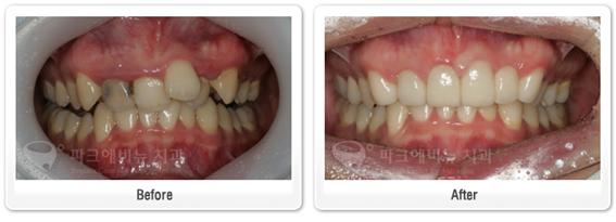 불규칙한치아-올세라믹 크라운 치아성형