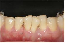올세라믹 크라운 치아성형 치료순서4