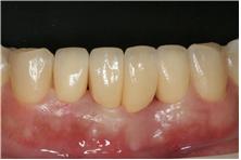 올세라믹 크라운 치아성형 치료순서5