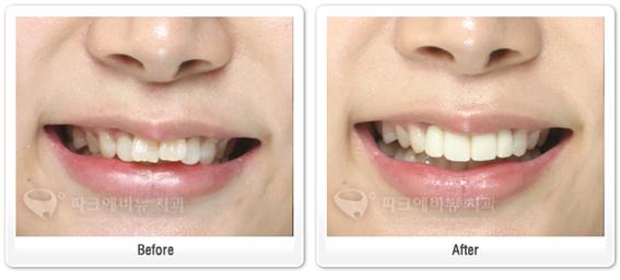 치아성형을 위한 올세라믹 크라운 장점과 치료순서, 사례