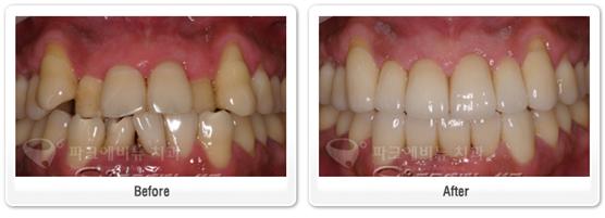 덧니-올세라믹 크라운 치아성형
