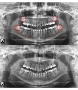 사랑니발치전후1