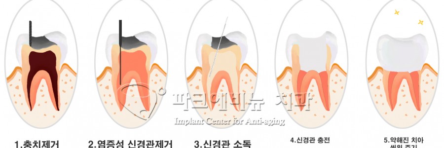 충치신경치료, 아프지 않은 수면 마취, 수면신경치료 추천!