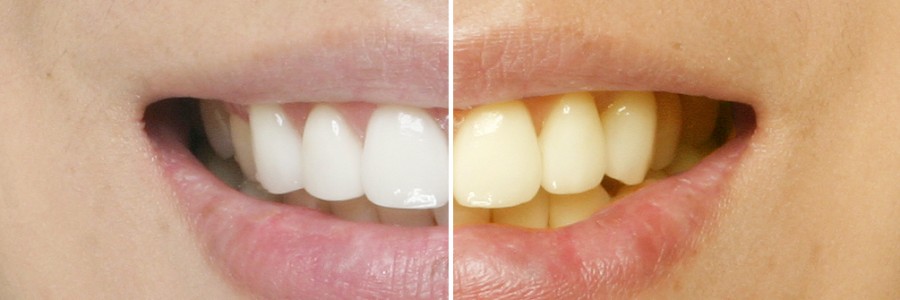 하루만에 밝아지는 치아미백, 원데이 치아미백!