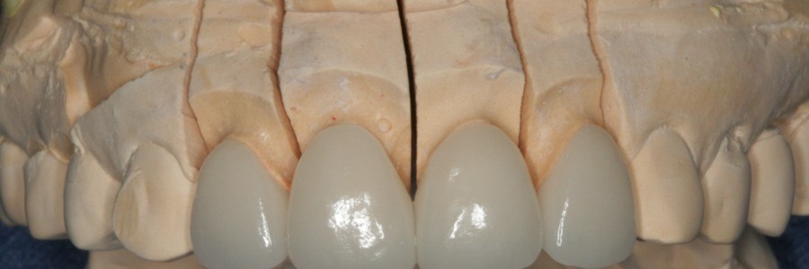 [수면라미네이트] 자면서 치과 라미네이트 치료 가능할까?