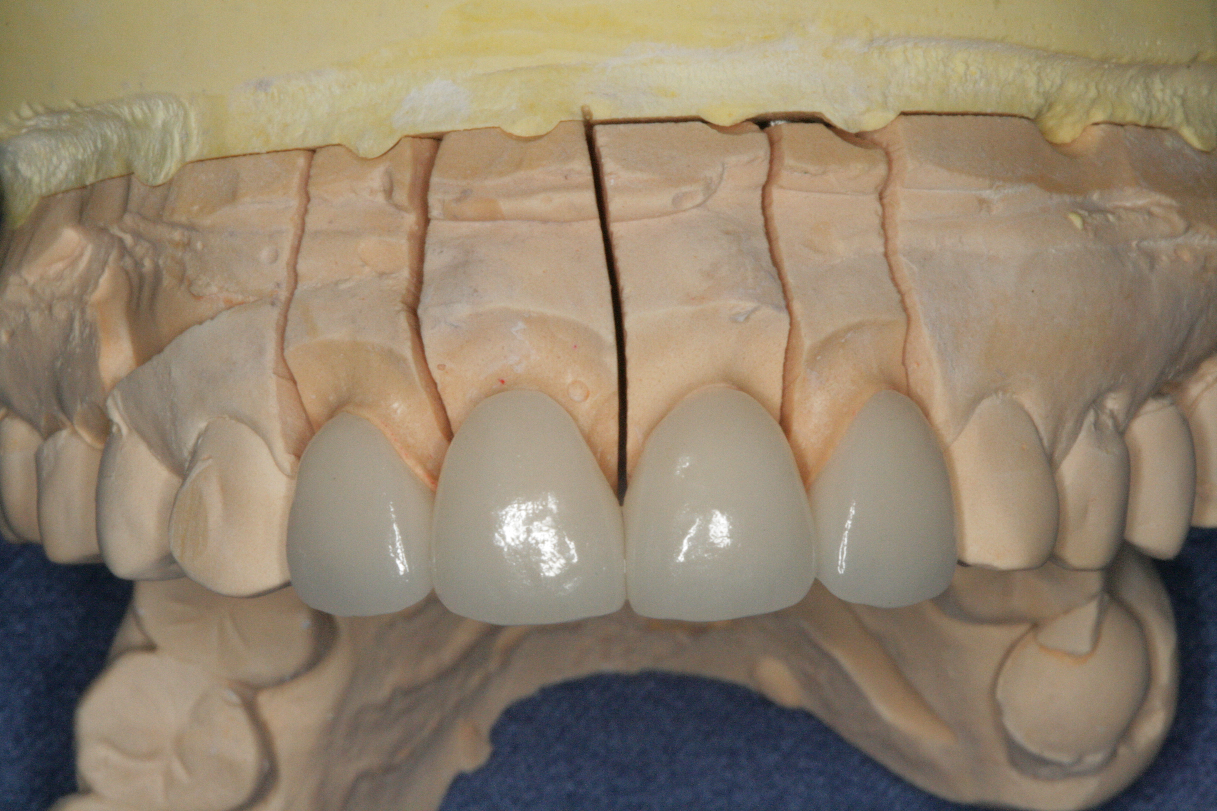 수면라미네이트