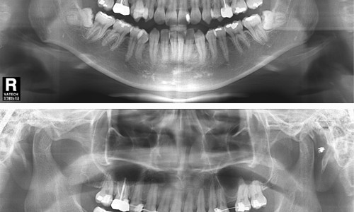 사랑니 발치 필수? 안아픈 매복 사랑니 발치!!