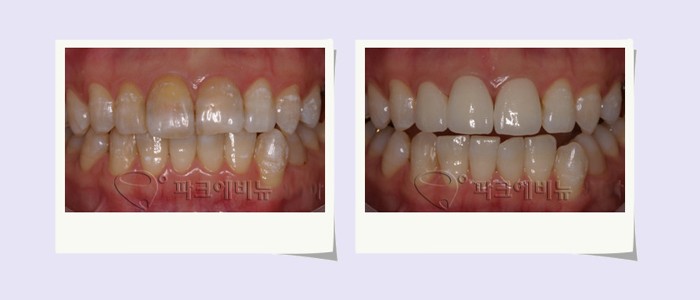 시커먼 잇몸, 해결책은 레이저 잇몸미백