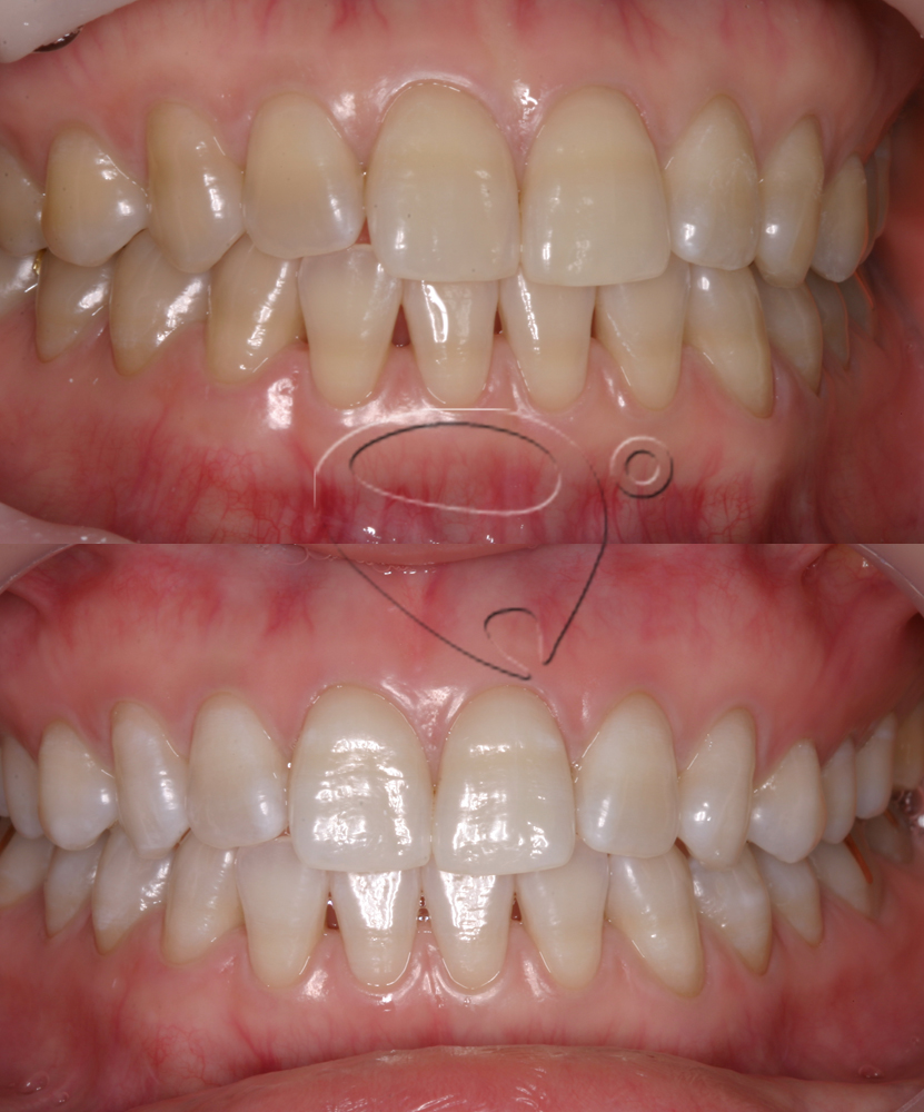 노경옥 미백전후 copy