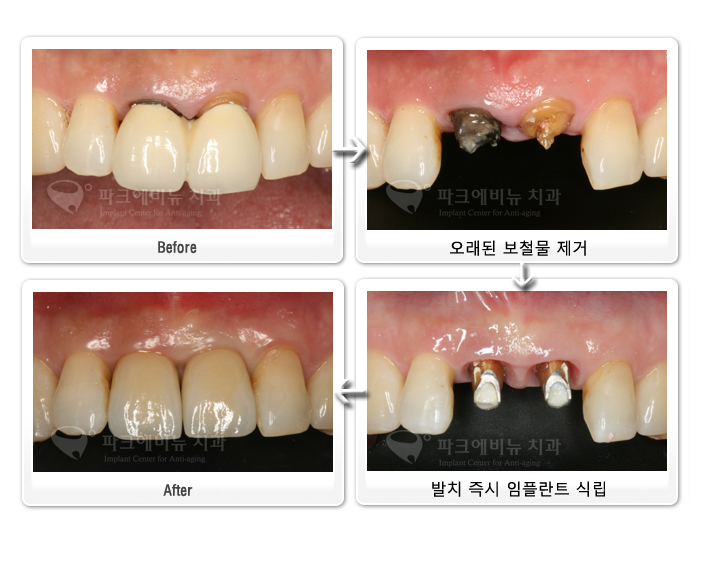 임플란트 보증제