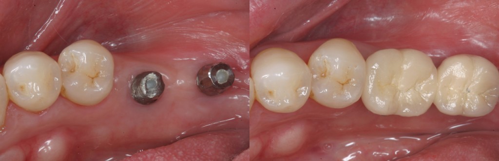 어금니임플란트