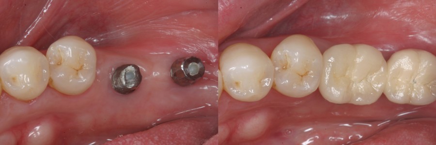[ 임플란트 ] 어금니 임플란트 수술과정