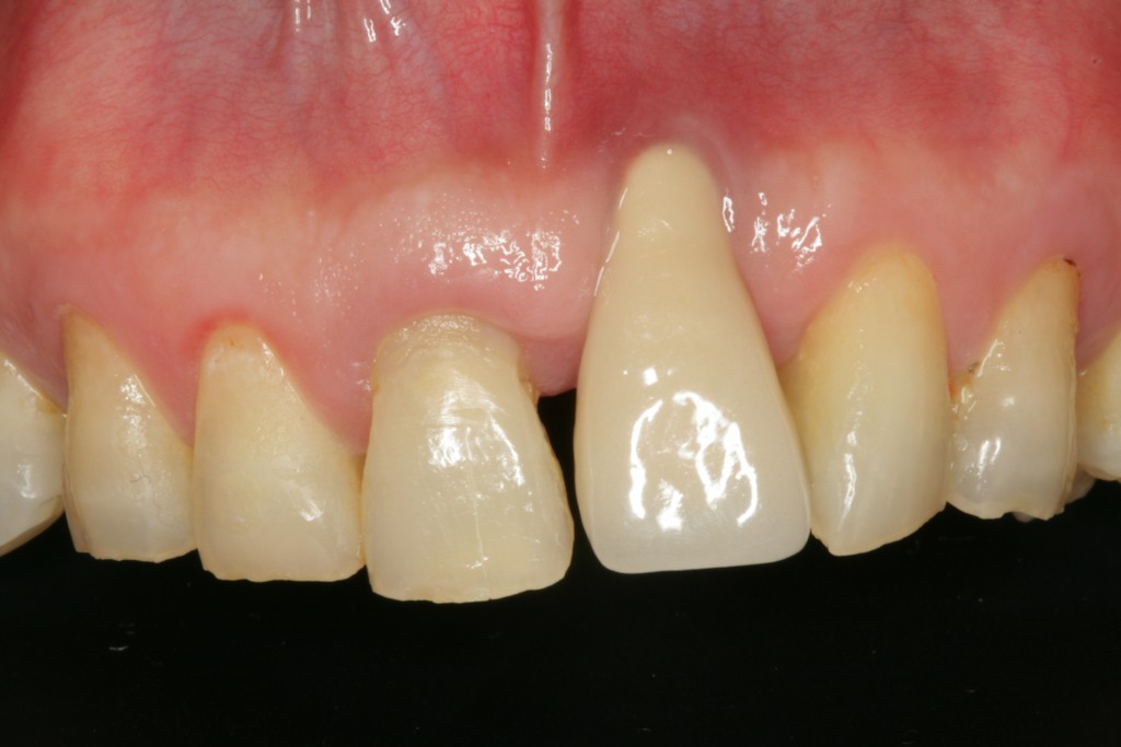 앞니 임플란트 재수술