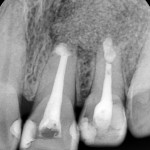 2013-07-26 PA 수술 후