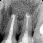 2013-11-16 PA 수술 후ck