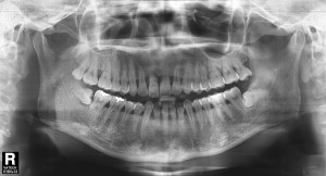 김정아 앞니 치료전