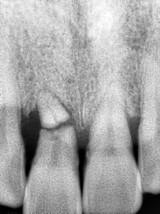 김정아 앞니 치료전 PA