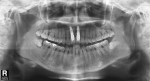 김정아 앞니 치료후