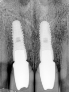 김정아 앞니 치료후 PA