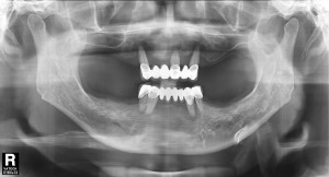 치료전 파노라마 20110916