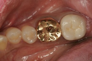 무통증 신경치료