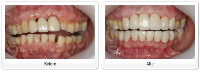 wenniy-hinde-오래된-보철 (1)