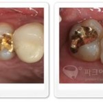 골드인레이 강남 충치치료 전문