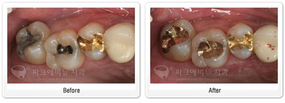 골드인레이 강남 충치치료 전문