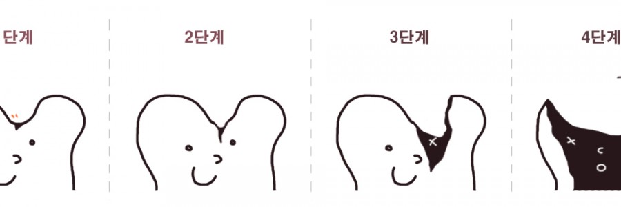 충치신경치료~ 이제는 수면마취로 편안하게!!