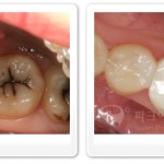 하얀색 이를 위한 오래된 아말감 제거 상담사례