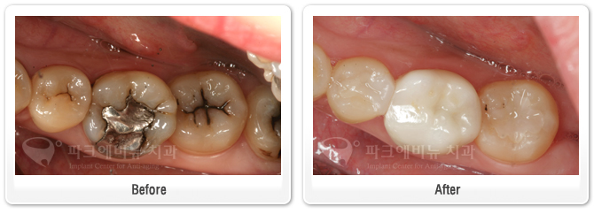 하얀색 이를 위한 오래된 아말감 제거 상담사례