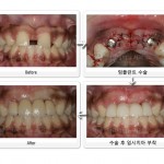 앞니임플란트- 임플란트 재수술치과- 강남 임플란트 치과