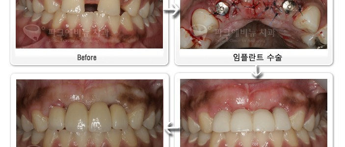앞니임플란트- 임플란트 재수술치과- 강남 임플란트 치과