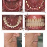 전체임플란트, 무치악임플란트 전문치과
