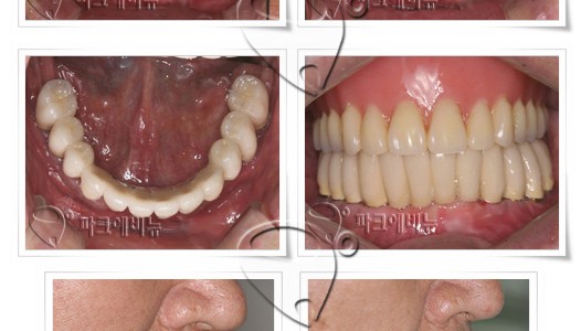 전체임플란트, 무치악임플란트 전문치과