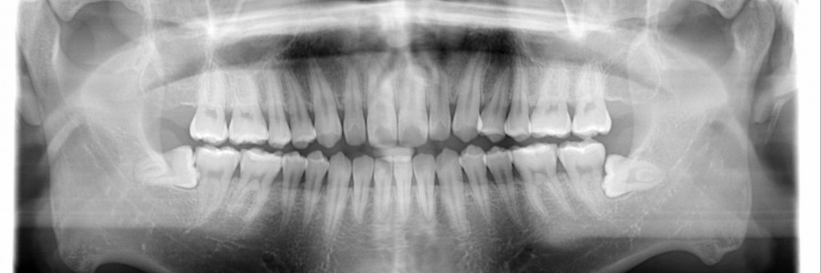 사랑니발치 Q&A, 사랑니발치의 모든것!