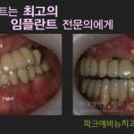 임플란트 보험적용 - 나이, 보험 부담비용, 등 소개합니다.